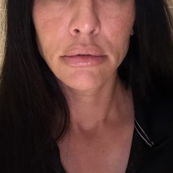 360 Lift Before & After Patient #8128