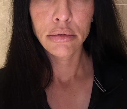 360 Lift Before & After Patient #8128