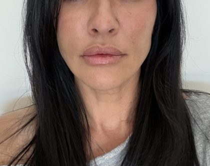 360 Lift Before & After Patient #8128