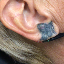 PicoSure Tattoo Removal Before & After Patient #8173