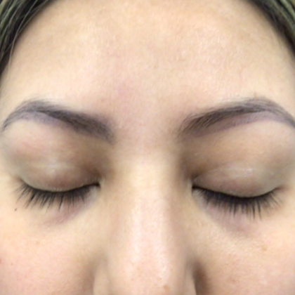 PicoSure Tattoo Removal Before & After Patient #8175