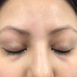 PicoSure Tattoo Removal Before & After Patient #8175