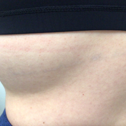 PicoSure Tattoo Removal Before & After Patient #8171