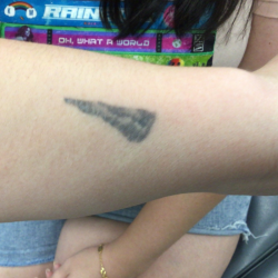 PicoSure Tattoo Removal Before & After Patient #8174