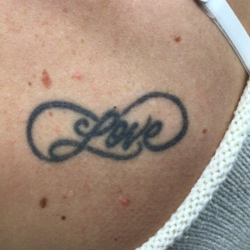 PicoSure Tattoo Removal Before & After Patient #8172
