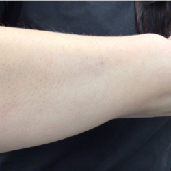 PicoSure Tattoo Removal Before & After Patient #8174