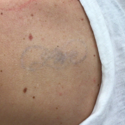 PicoSure Tattoo Removal Before & After Patient #8172