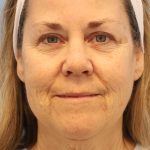 Neck Liposuction Before & After Patient #8215