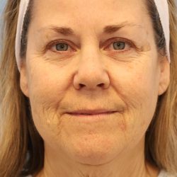 Neck Liposuction Before & After Patient #8215