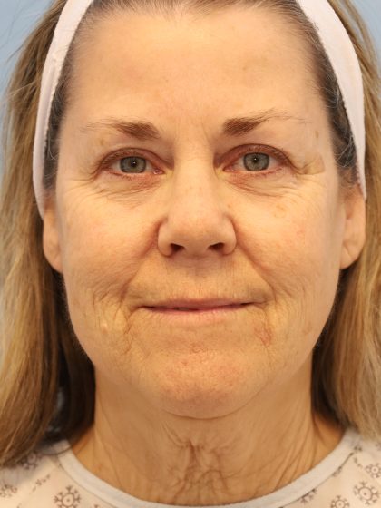 Neck Liposuction Before & After Patient #8215