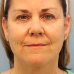 Neck Liposuction Before & After Patient #8215