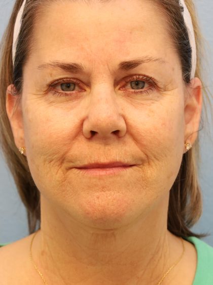 Neck Liposuction Before & After Patient #8215