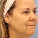 Neck Liposuction Before & After Patient #8215