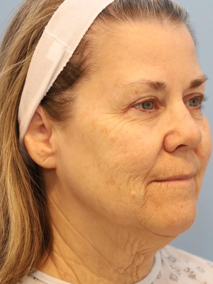 Neck Liposuction Before & After Patient #8215