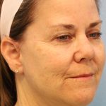 Neck Liposuction Before & After Patient #8215