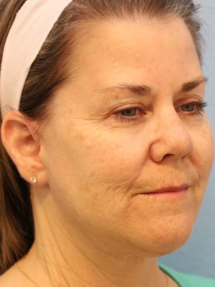 Neck Liposuction Before & After Patient #8215