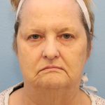 Mini Facelift Before & After Patient #8207