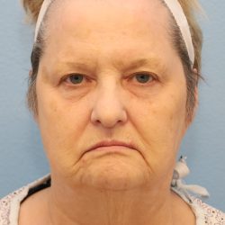 Mini Facelift Before & After Patient #8207