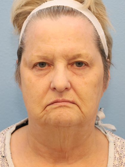 Mini Facelift Before & After Patient #8207