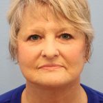 Mini Facelift Before & After Patient #8207