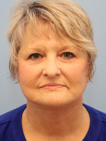Mini Facelift Before & After Patient #8207