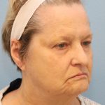 Mini Facelift Before & After Patient #8207