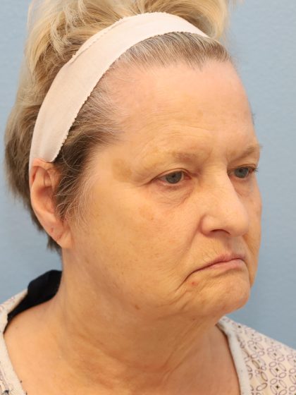 Mini Facelift Before & After Patient #8207