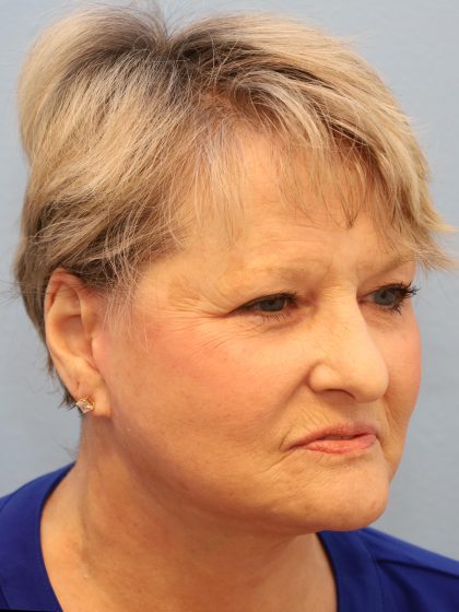 Mini Facelift Before & After Patient #8207
