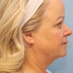 Neck Liposuction Before & After Patient #8206