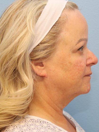 Neck Liposuction Before & After Patient #8206