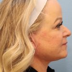 Neck Liposuction Before & After Patient #8206