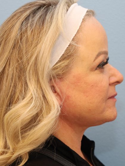 Neck Liposuction Before & After Patient #8206