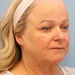 Neck Liposuction Before & After Patient #8206