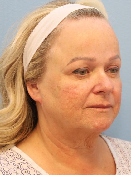 Neck Liposuction Before & After Patient #8206