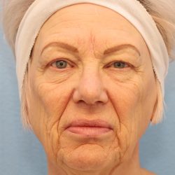 Mini Facelift Before & After Patient #8217