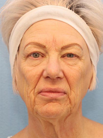 Mini Facelift Before & After Patient #8217