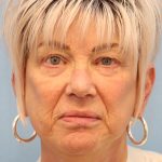 Mini Facelift Before & After Patient #8217