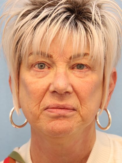 Mini Facelift Before & After Patient #8217