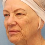 Mini Facelift Before & After Patient #8217