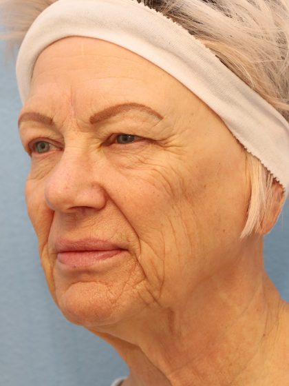 Mini Facelift Before & After Patient #8217