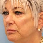 Mini Facelift Before & After Patient #8217