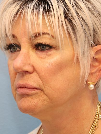 Mini Facelift Before & After Patient #8217