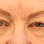 Blepharoplasty Before & After Patient #8209