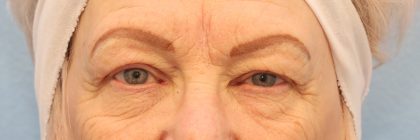 Blepharoplasty Before & After Patient #8209