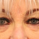 Blepharoplasty Before & After Patient #8209