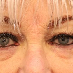 Blepharoplasty Before & After Patient #8209