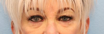 Blepharoplasty Before & After Patient #8209