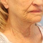 Mini Facelift Before & After Patient #8208