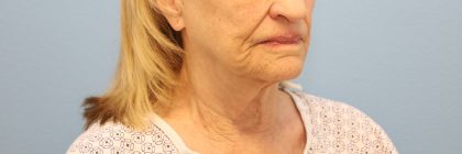 Mini Facelift Before & After Patient #8208