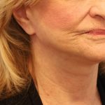 Mini Facelift Before & After Patient #8208